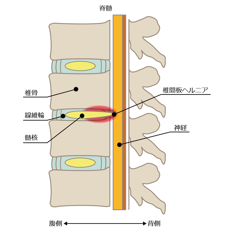 椎間板変性症（側面図）