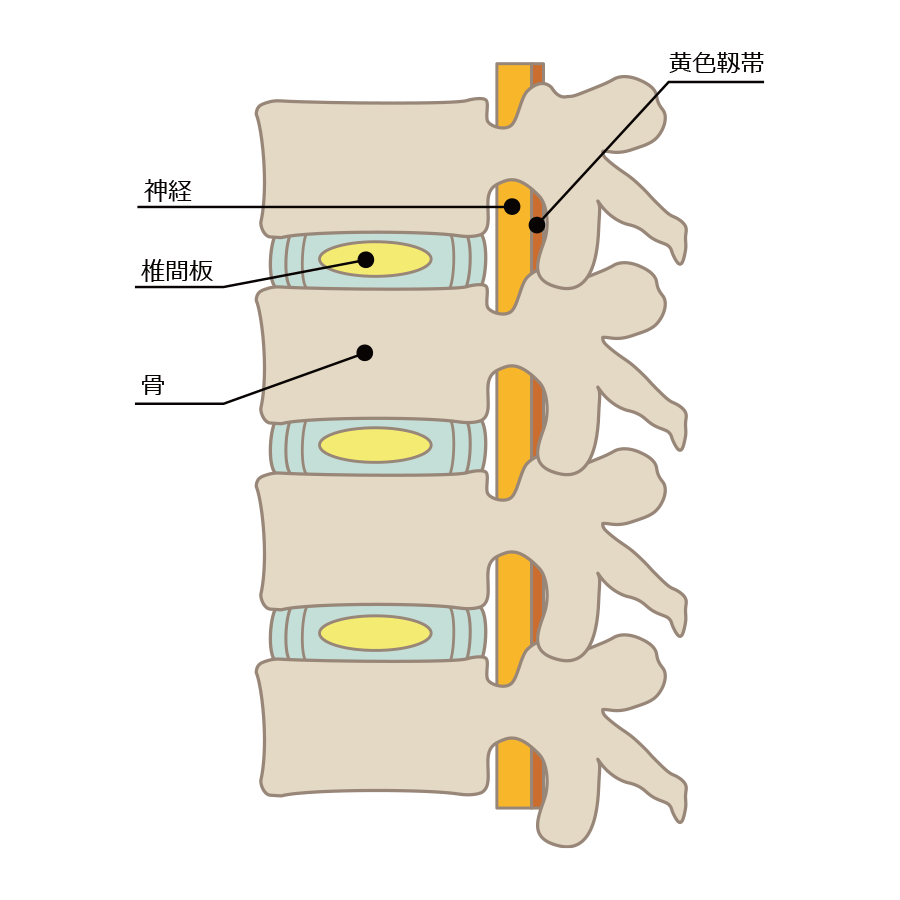 椎間板（側面図）と腰部脊柱管狭窄症