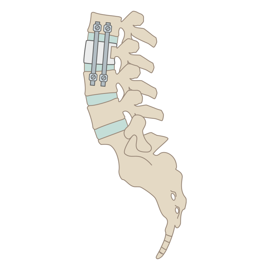 前方椎体固定術