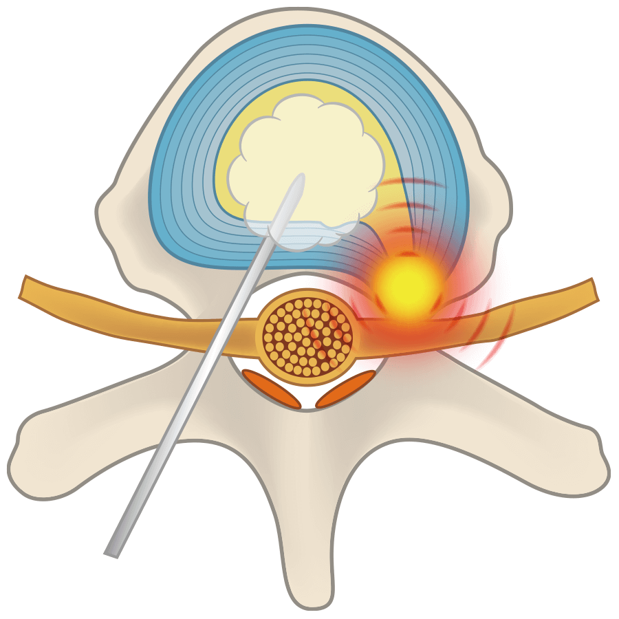 PODT法 - 経皮的椎間板オゾン治療