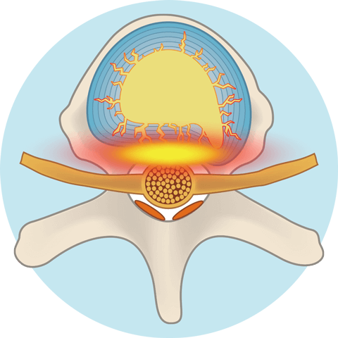 損傷した椎間板