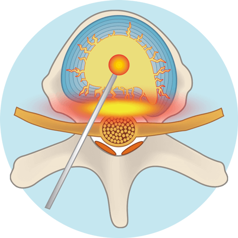 NST針にて椎間板（髄核）に治療薬を注入します。
