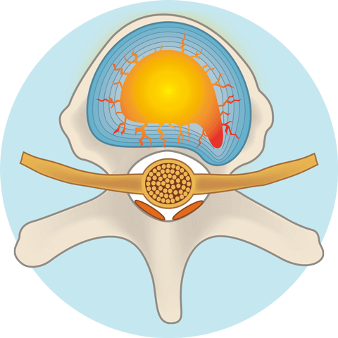 椎間板（髄核）に治療薬が浸透します。