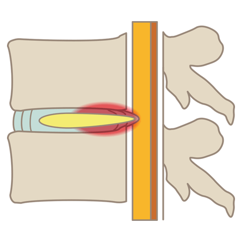 腰椎椎間板ヘルニア