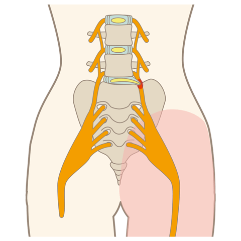 坐骨神経痛