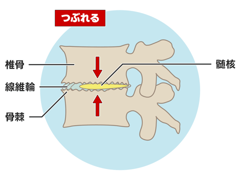 椎間板変性症