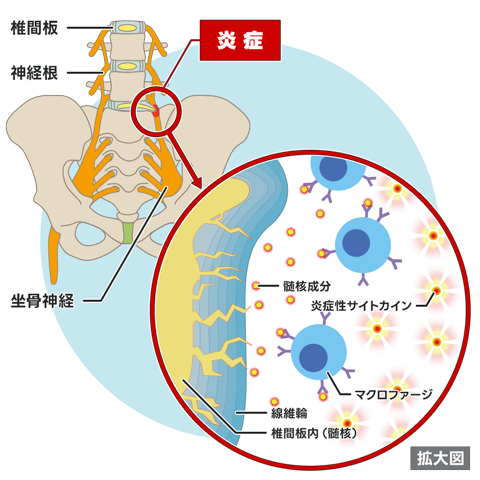 坐骨神経痛
