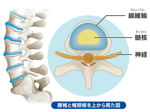 日帰り腰痛治療