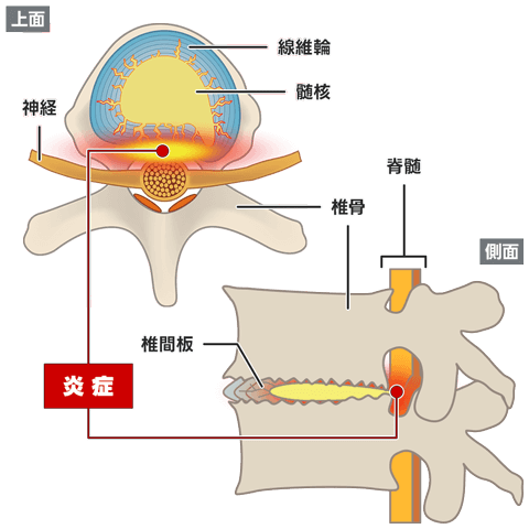 椎間板に損傷があるタイプ