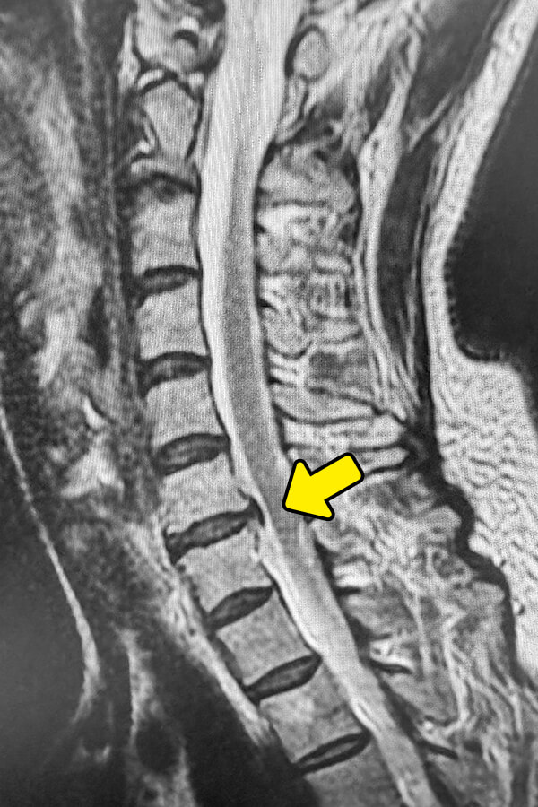 頚椎椎間板ヘルニアの検査と診断
