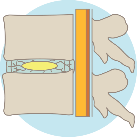 頚椎症のメカニズム：椎間板の変性
