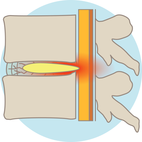 頚椎椎間板ヘルニアのメカニズム：ヘルニアの発生
