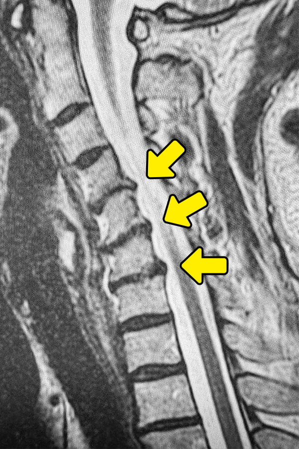 頚椎椎間板変性症の検査と診断