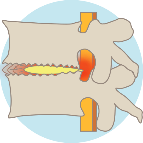 頚椎症のメカニズム：ヘルニアの発生
