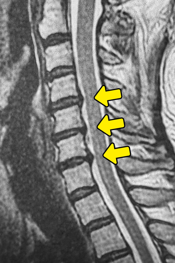 頚椎症の検査と診断