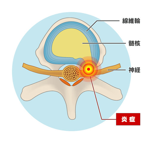 椎間板（上面図）