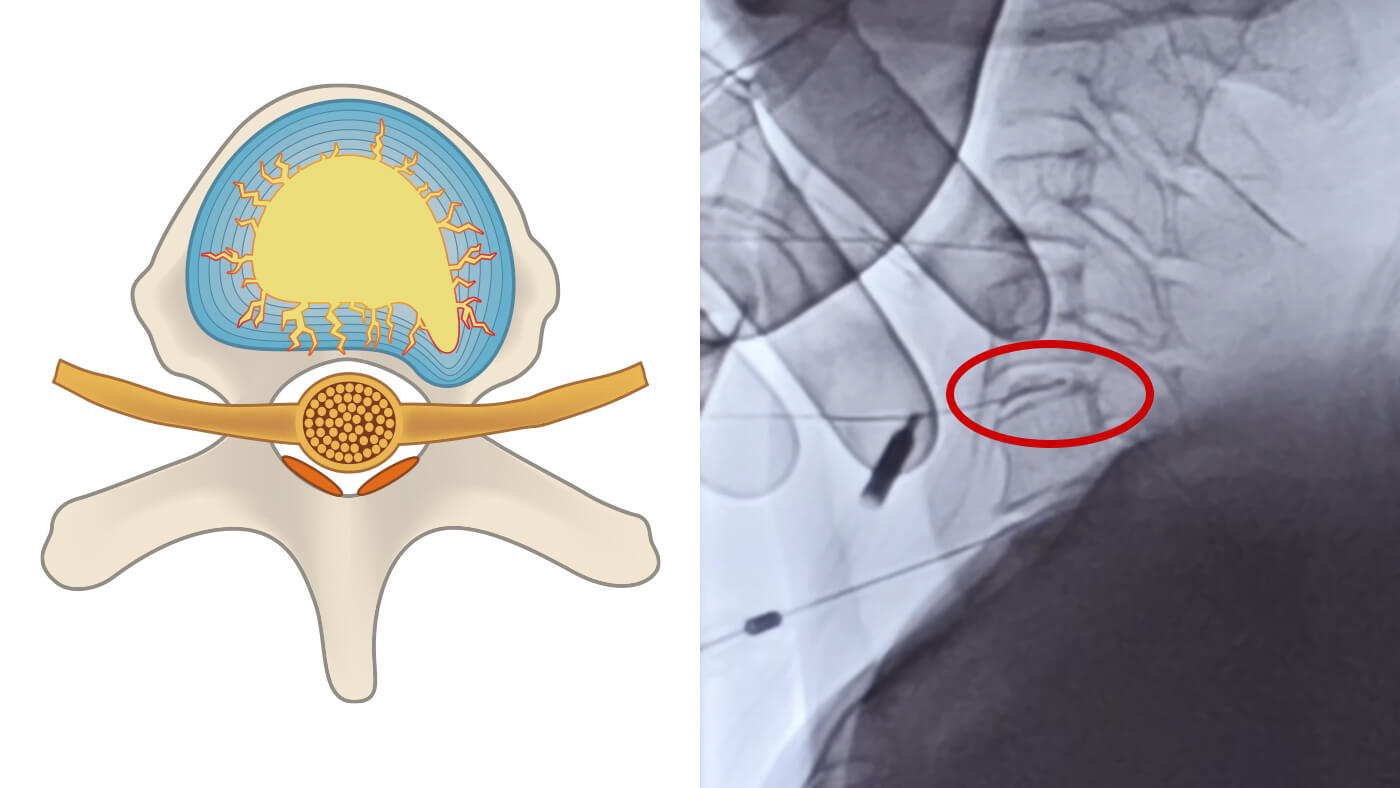 椎間板の治療と修復過程：1.損傷部位の特定