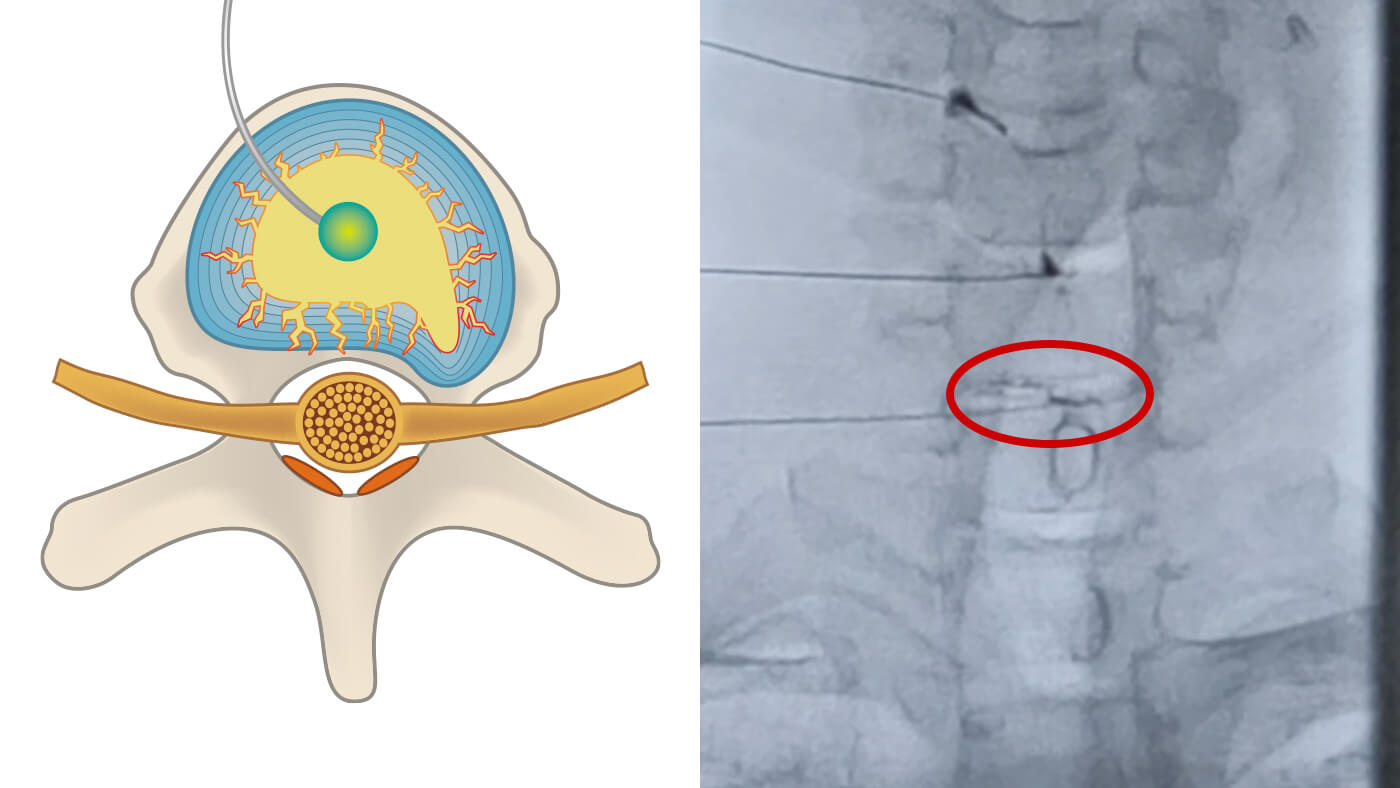椎間板の治療と修復過程：2.治療薬の注入