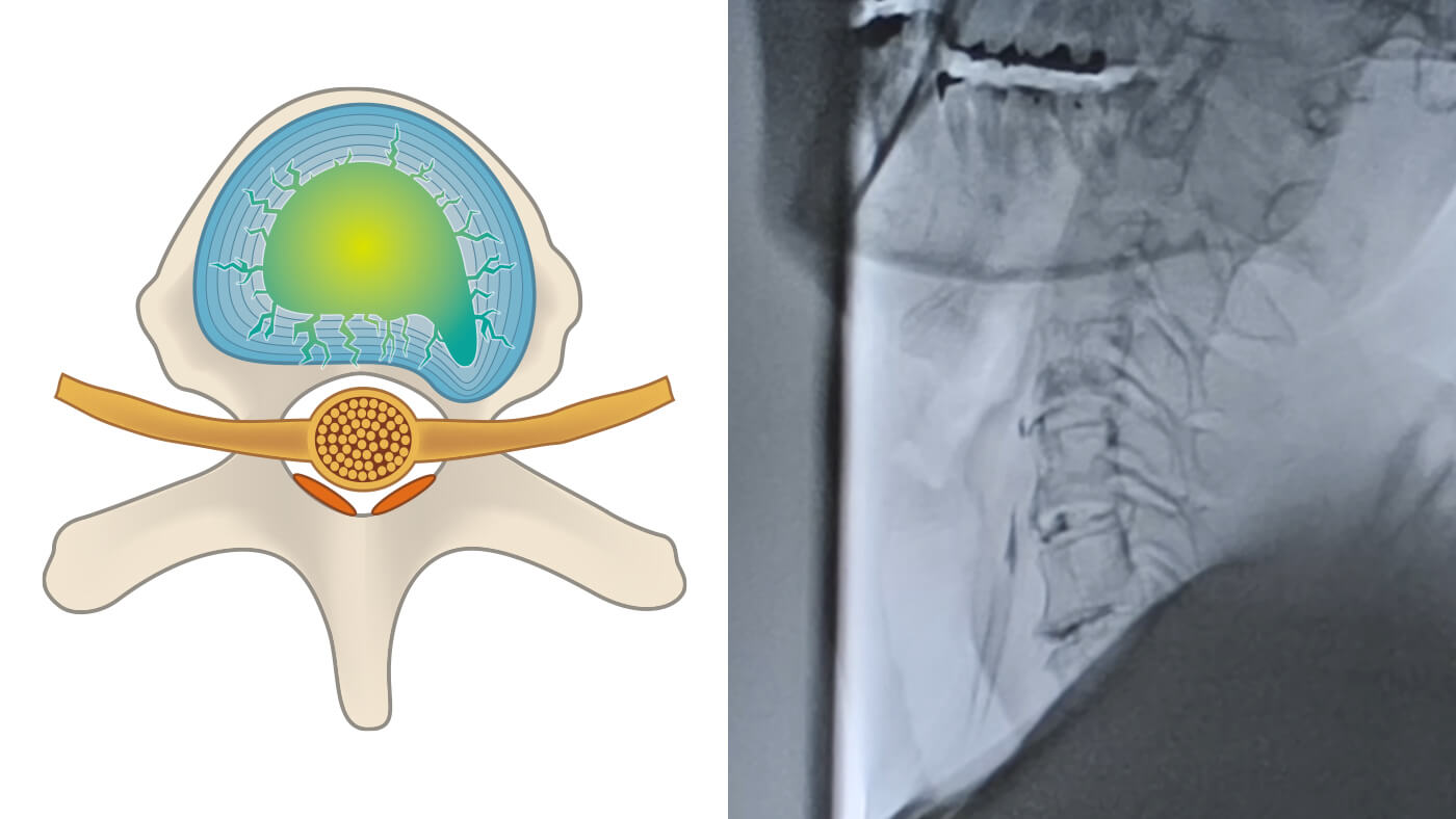 椎間板の治療と修復過程：3.亀裂の密封と修復