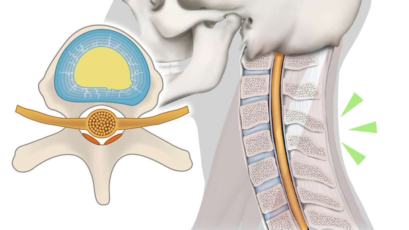 椎間板の治療と修復過程：4.機能回復への期待