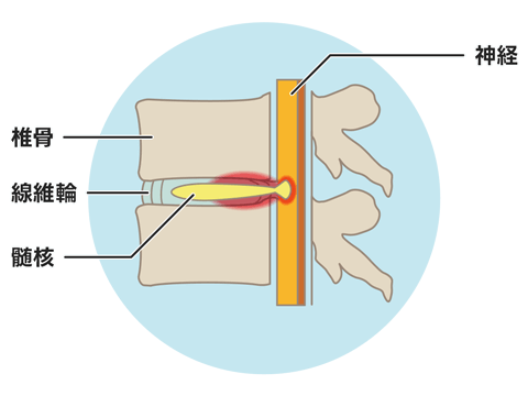 頚椎椎間板ヘルニア（脱出型）
