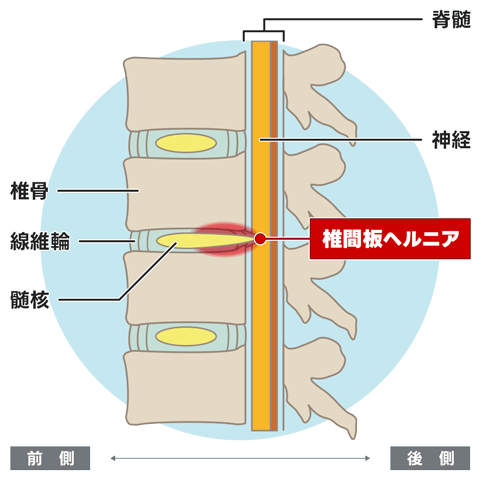 椎間板（側面図）