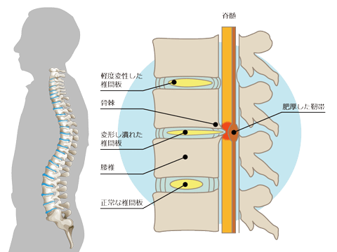 椎間板（側面図）と腰部脊柱管狭窄症