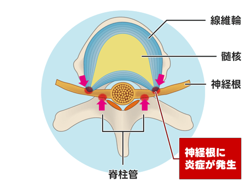 腰部脊柱管狭窄症（神経根型）