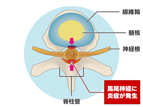 腰部脊柱管狭窄症（馬尾型）