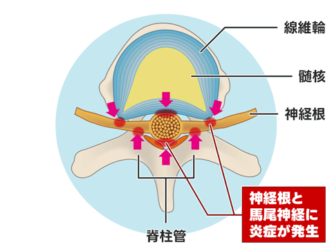 腰部脊柱管狭窄症（混合型）