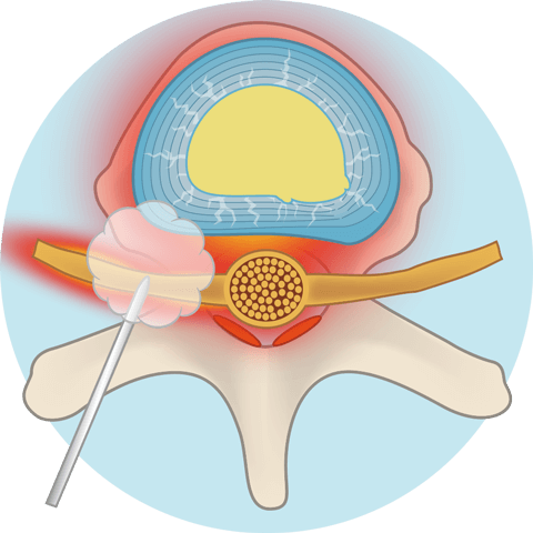 椎間板の外にオゾンガスを噴出します。