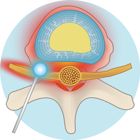 椎間板の外にSTRを注入します。