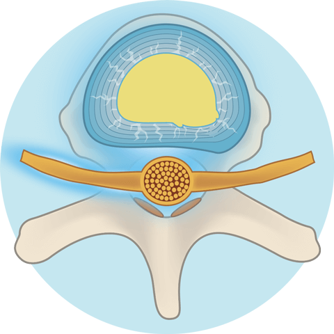 椎間板の周辺組織の抗炎症作用や傷害組織の改善を促します。