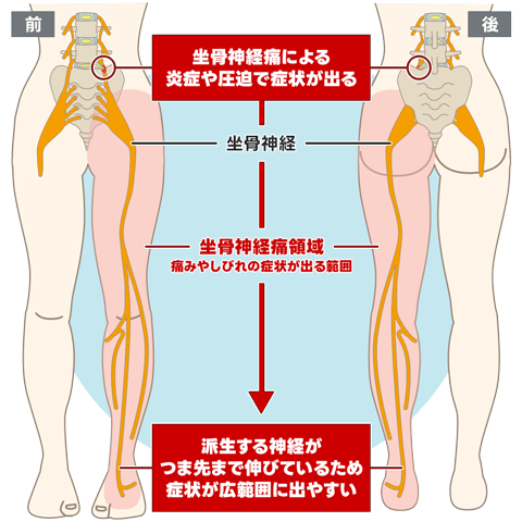 坐骨神経痛