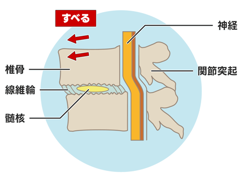 腰椎変性すべり症