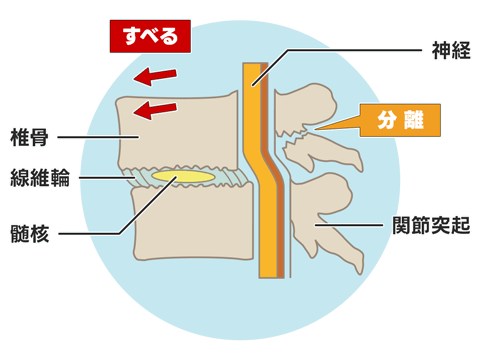 腰椎分離すべり症