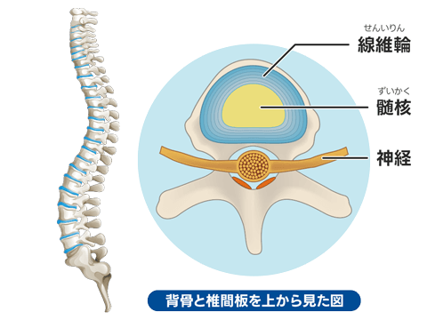 日帰り椎間板治療