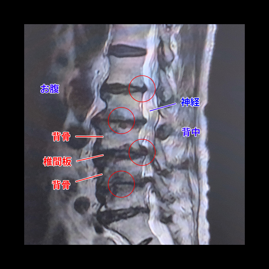 MRI