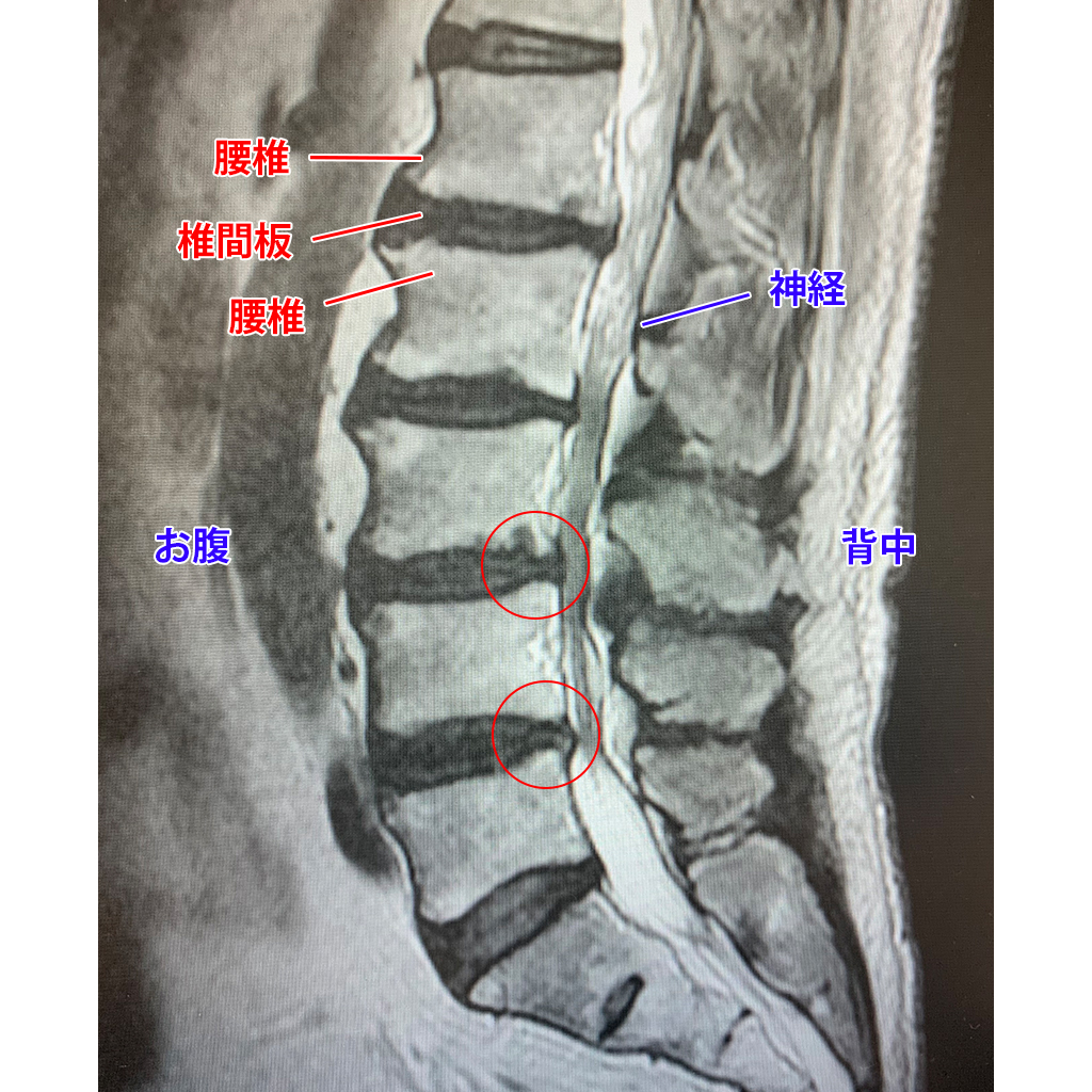 MRI