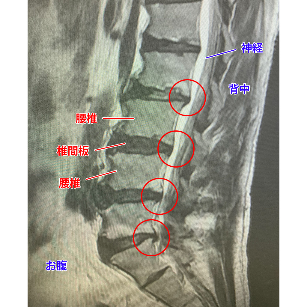 MRI