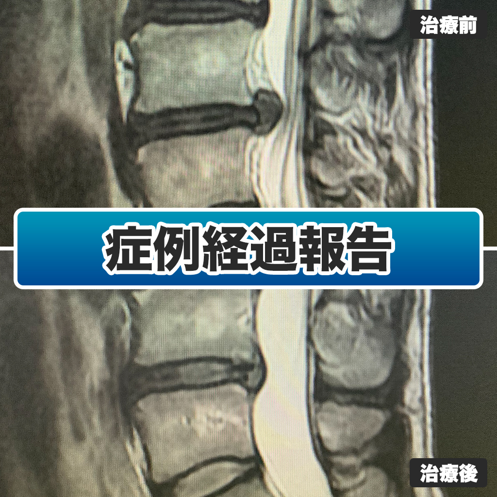 標準的神経治療 GI-BONEを用いて治療選択と病勢評価を行った前立腺癌症例 | 日本