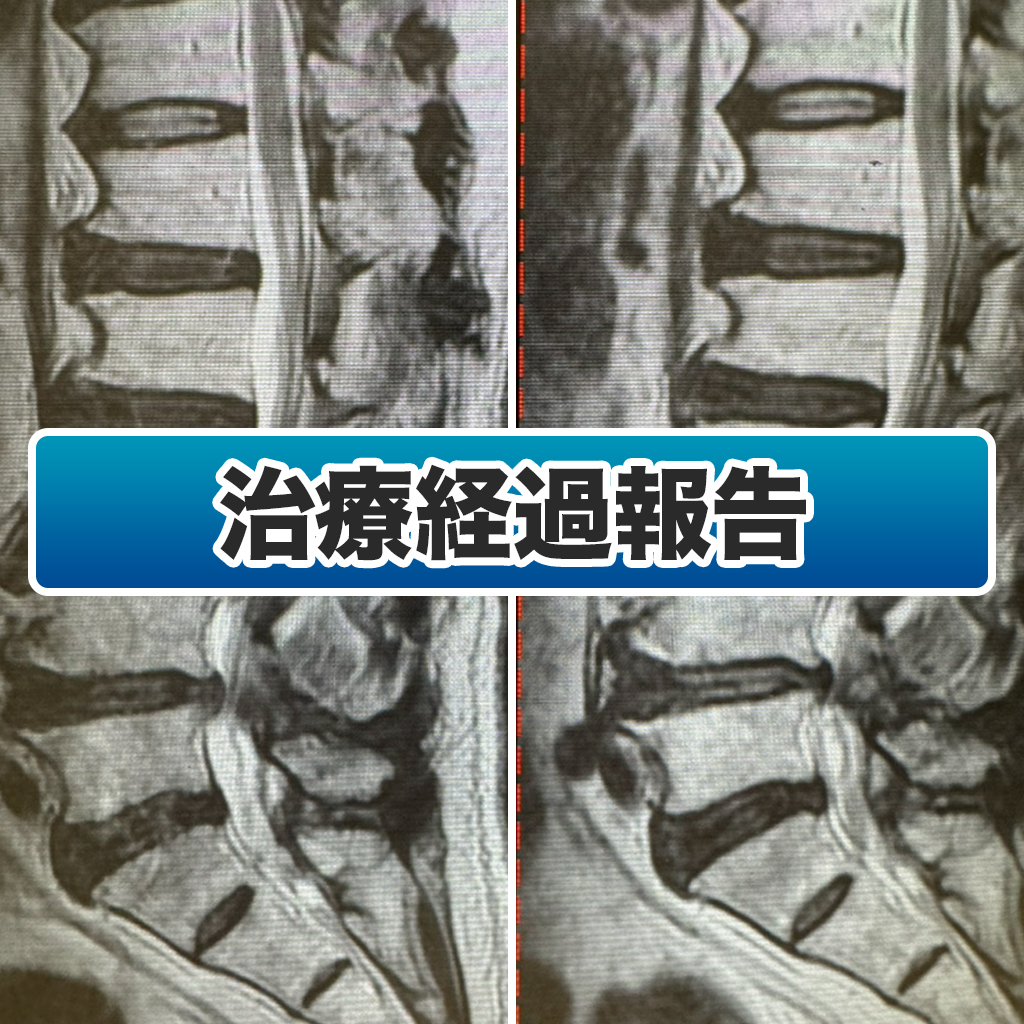 標準的神経治療 神経線維腫症1型患者さんが年齢にかかわらず利用できる医療費助成制度