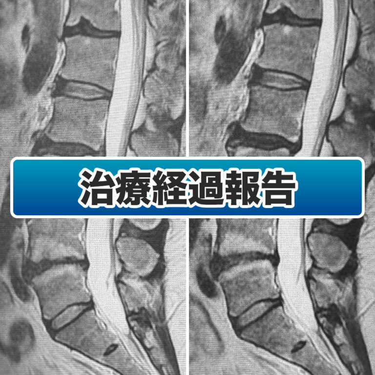 治療後1年、腰の痛みがとれない