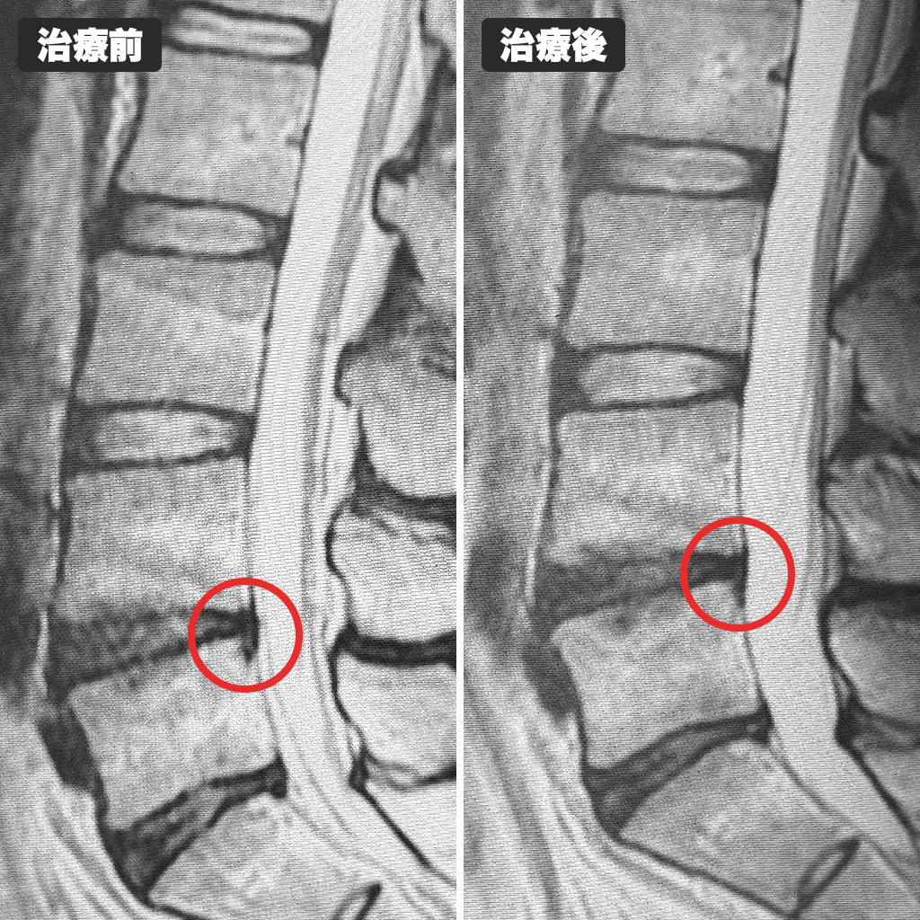 治療前後のMRI写真