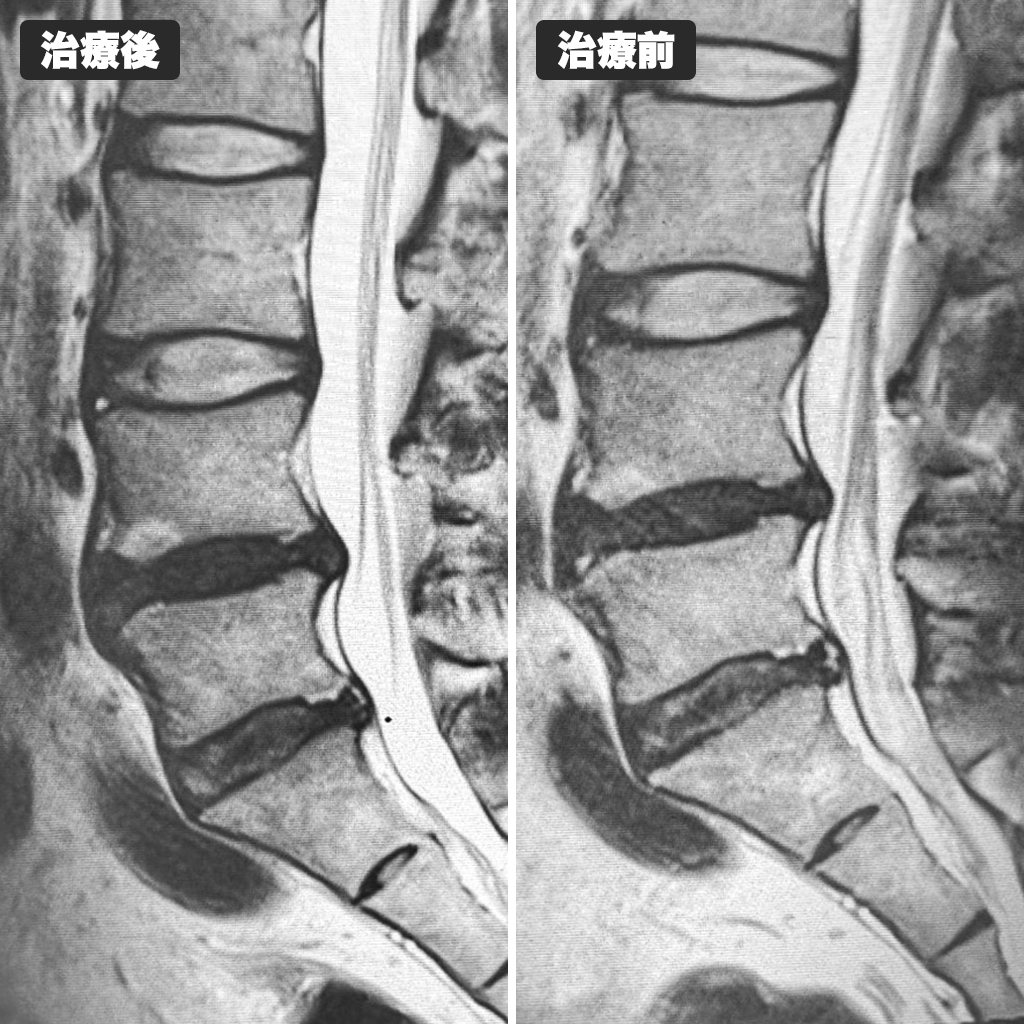 治療前後のMRI写真