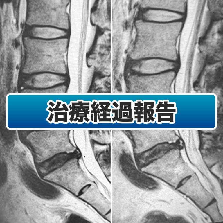 ディスクシール治療後3ヵ月経過した40代男性