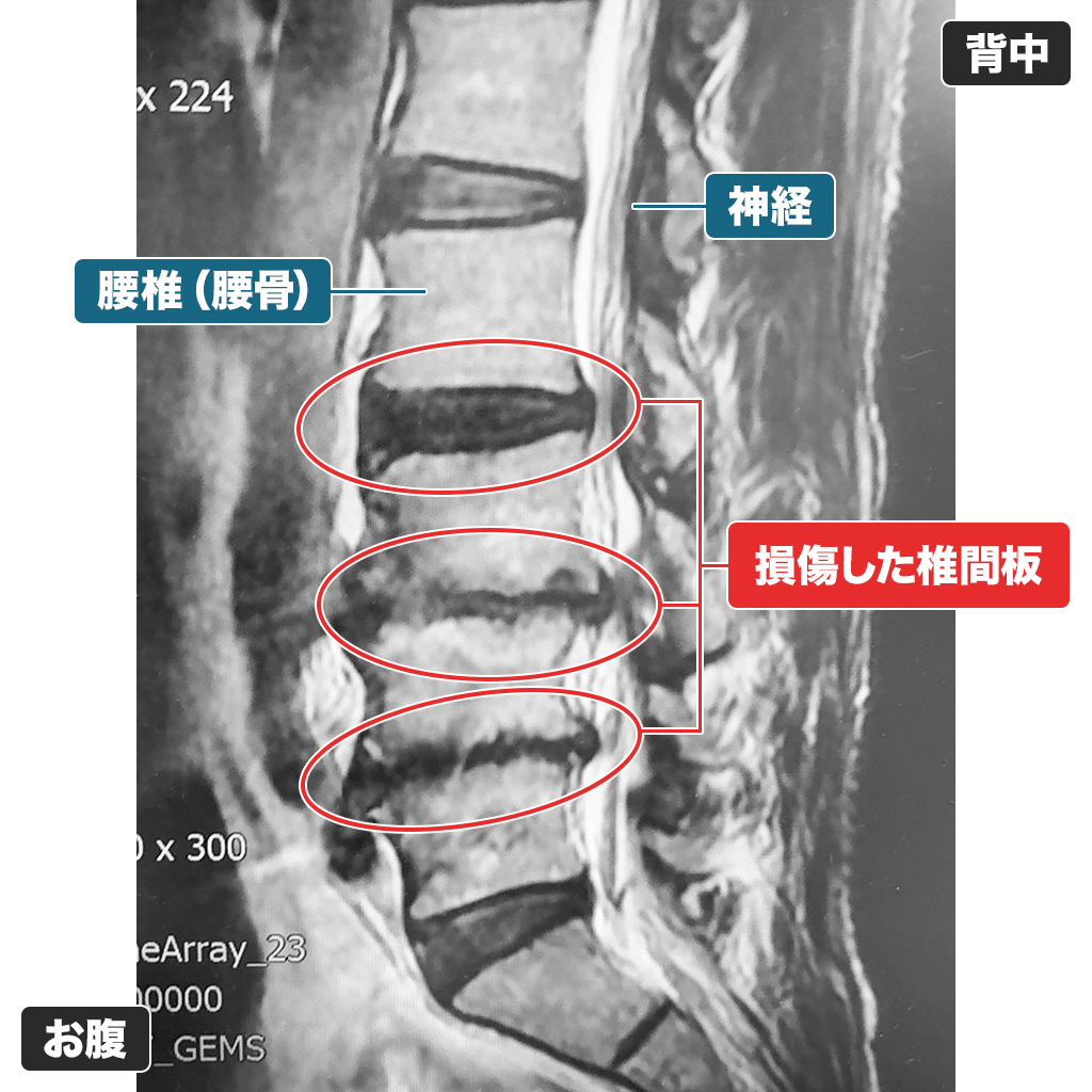 MRI