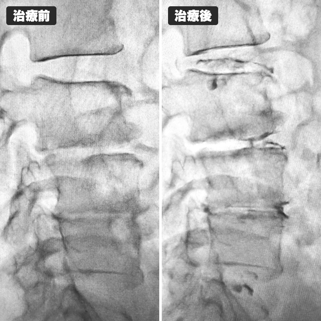 治療前後のレントゲン写真