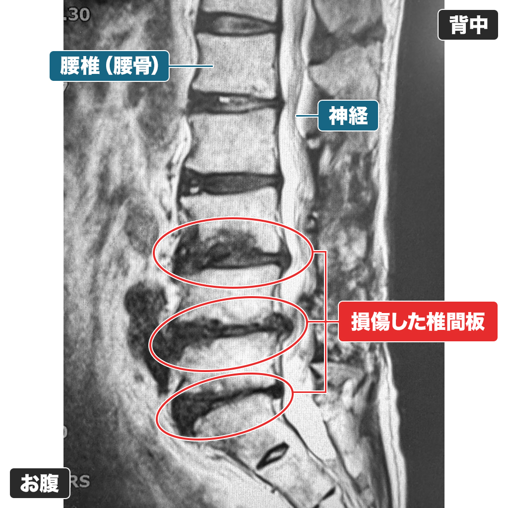 MRI