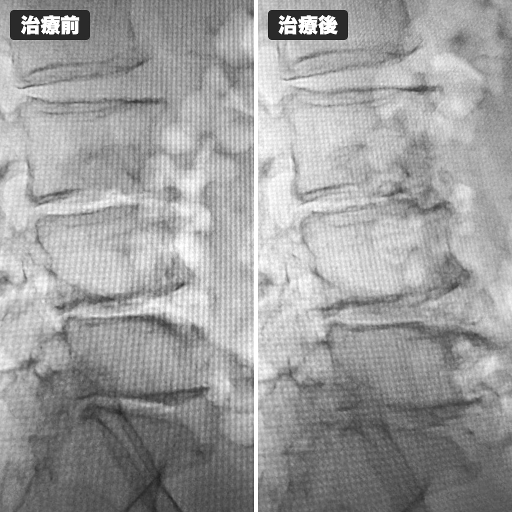 治療前後のレントゲン写真